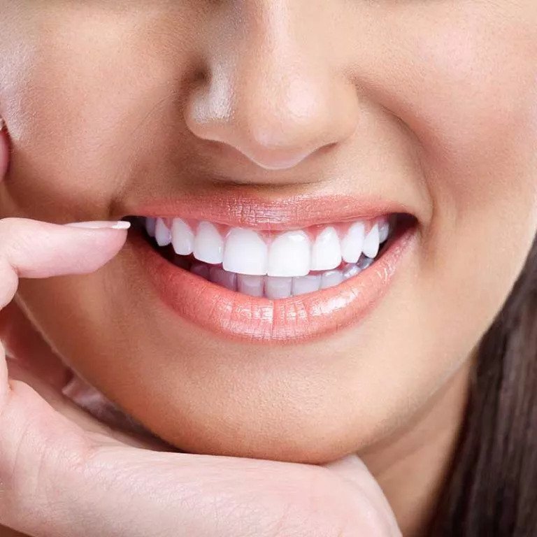 Veneer Services